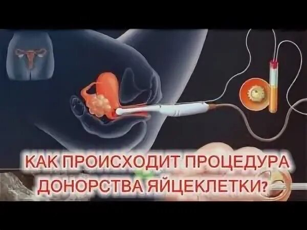 Донор яйцеклетки. Донорство яйцеклетки (ооцитов). Как происходит донорство яйцеклетки. Донорство ооцитов последствия.