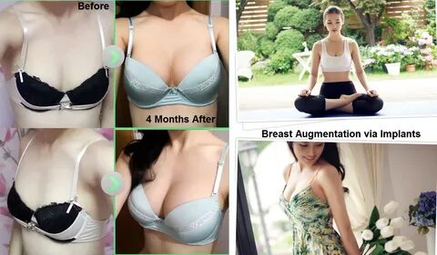 14 breast augmentation via implants and lift before and after seoul guide m...