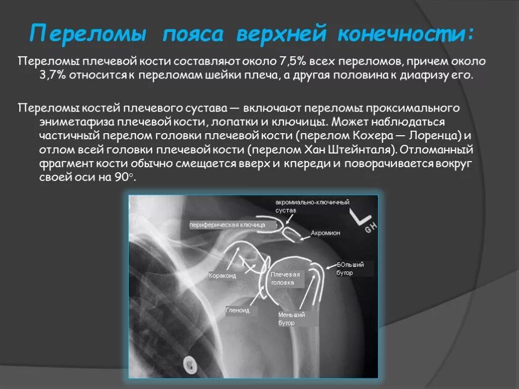 Перелом кости может быть каким. Переломы шейки плечевой кости классификация. Перелом верхней трети плечевой кости рентген. Перелом плечевой кости классификация рентген. Перелом шейки плечевой кости кт.