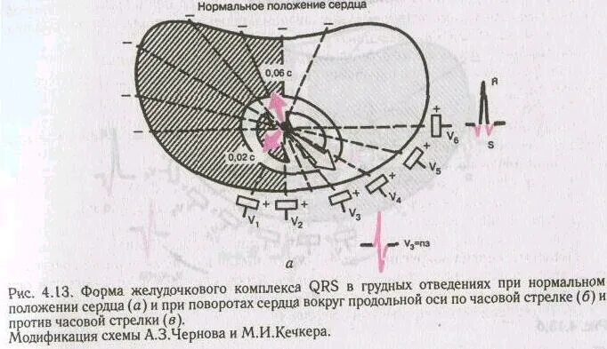 ЭКГ при поворотах сердца вокруг продольной оси. Повороты сердца на ЭКГ вокруг продольной оси. Поворот сердца вокруг продольной оси по часовой стрелке на ЭКГ. Поворот сердца по продольной оси против часовой стрелки. Поворот правым желудочком вперед