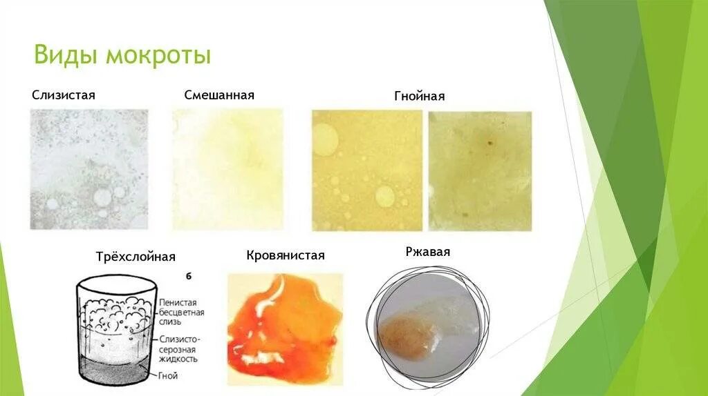 Почему утром мокрота. Типы мокроты при коронавирусе. Желтый канареечный цвет мокроты.