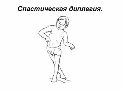 Спастическая форма детского церебрального паралича