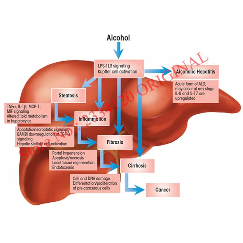 Alcoholic disease. Алкоголь и печень рисунок. Alcoholic disease. Alcoholic disease. Alcoholic disease.