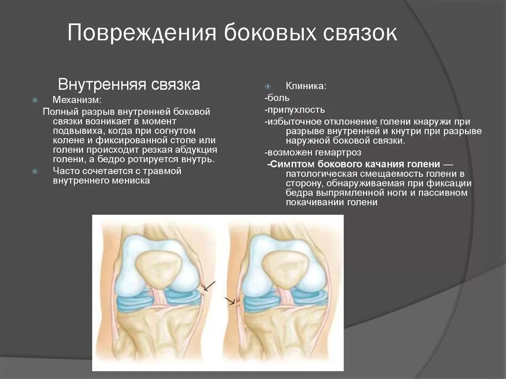 Повреждение боковых связок коленного сустава. Разрыв внутренней боковой связки. Разрыв внутренней боковой связки коленного сустава. Надрыв внутренней боковой связки коленного сустава.