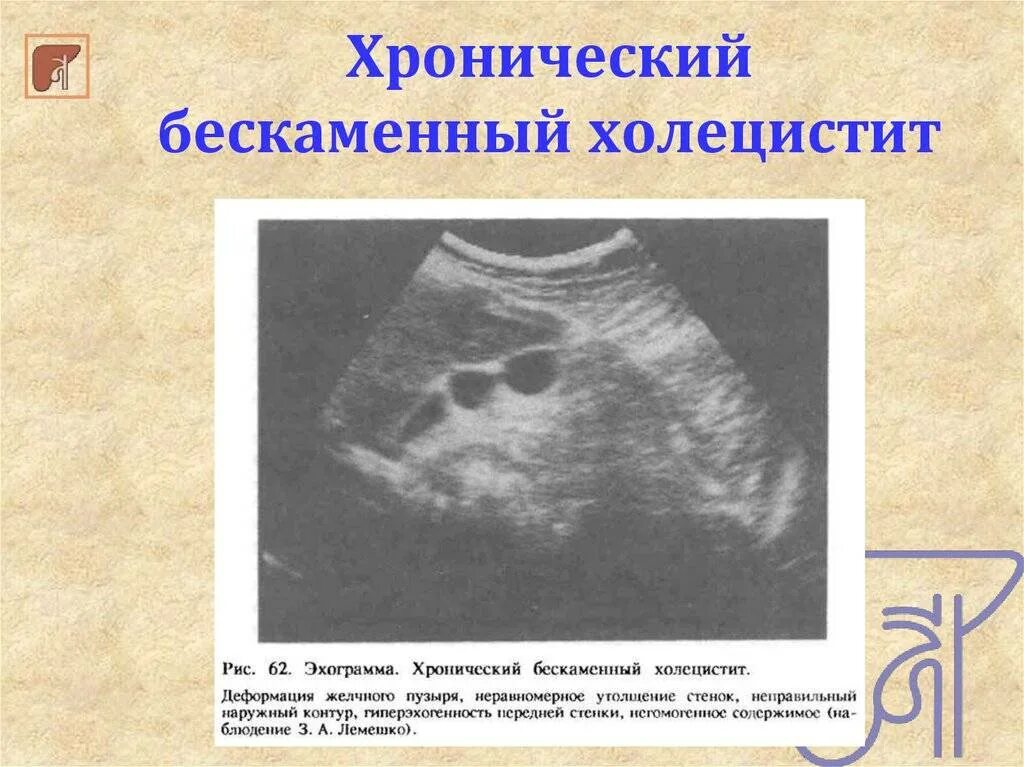 Бескаменный холецистит лечение. Хронический бескаменный холецистит УЗИ. Хронический не калькулёзный холецистит УЗИ. УЗИ желчного пузыря бескаменный холецистит. Хронический некалькулезный холецистит УЗИ.