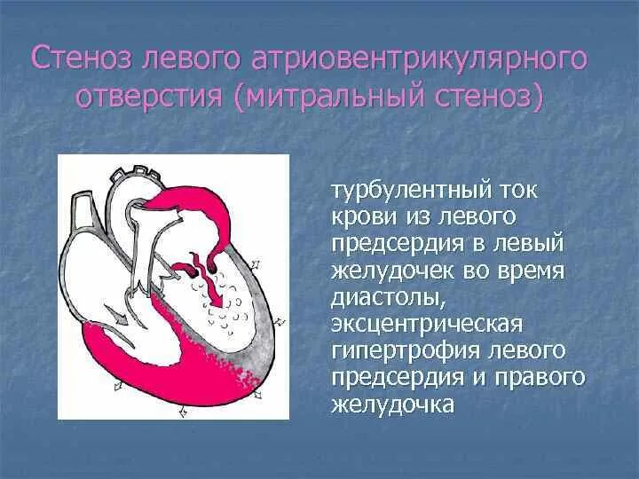 Гипертрофия митрального клапана левого желудочка. Гипертрофия митрального клапана левого желудочка. Гипертоническая болезнь и гипертрофия левого желудочка. Стеноз атриовентрикулярного клапана. Гипертрофия миокарда левого желудочка при артериальной гипертензии.