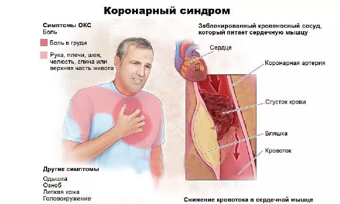 Острый коронарный синдром причины патогенез. Синдром острой коронарной недостаточности патогенез. Острый коронарный синдром клинические проявления. Купирование острого коронарного синдрома. Есть окс