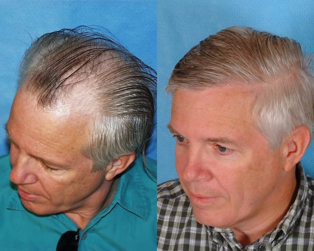 Волосы зализанные на лысину. Дональд трамп прическа лысина. Как скрыть лысину. Зачесанная лысина. Гарет бэйл лысеет.