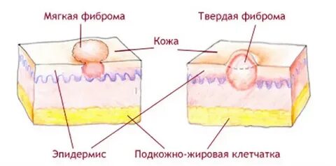 Доброкачественных новообразований подкожно жировой клетчатки