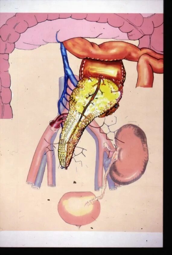 Трансплантация поджелудочной железы. Трансплантология почки. Почечный трансплантат. Пересадка поджелудочной железы при сахарном диабете