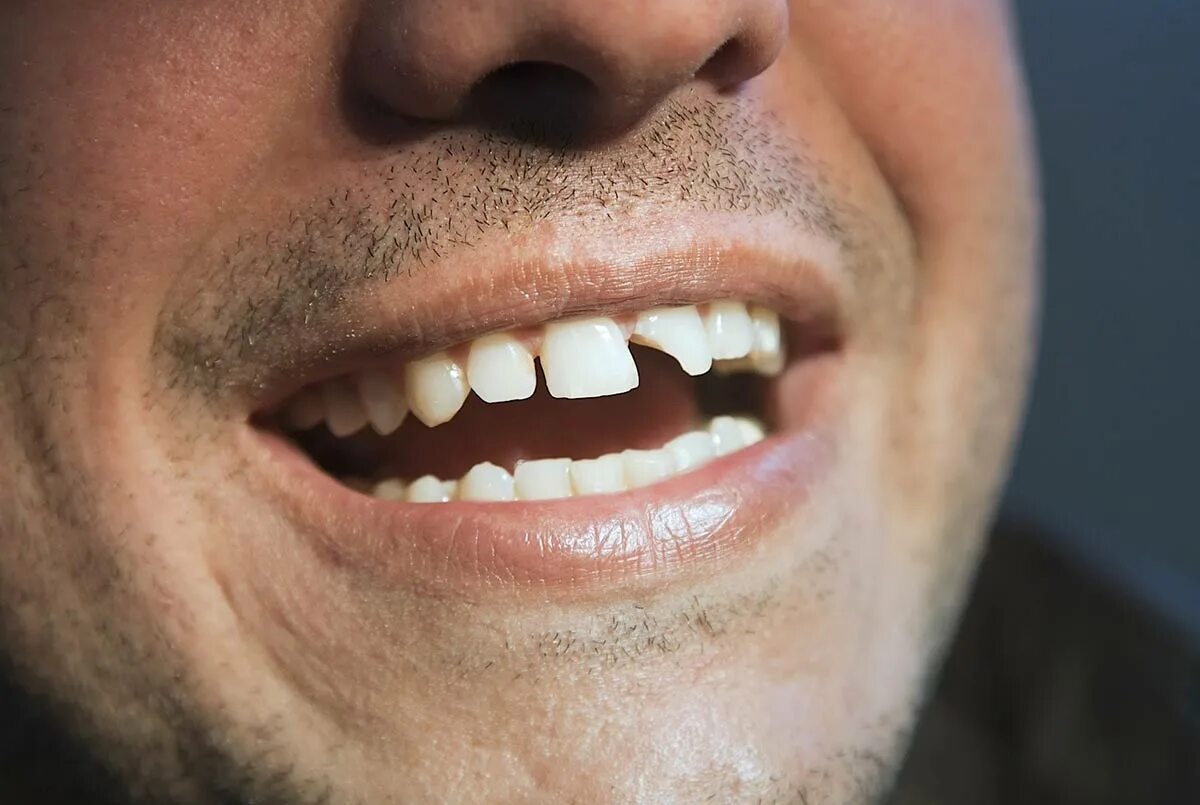 Украшения для зубов скайсы. Рудой зубы. Рудой зубы. Открытый рот. Рудой зубы.