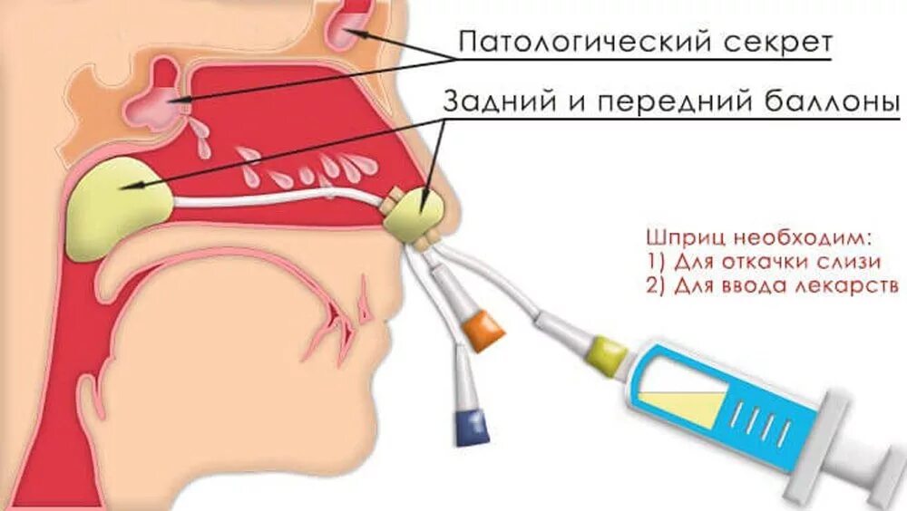 Гнойный насморк у взрослых. Промывание пазух носа синус катетером ЯМИК. Назальный катетер ЯМИК.