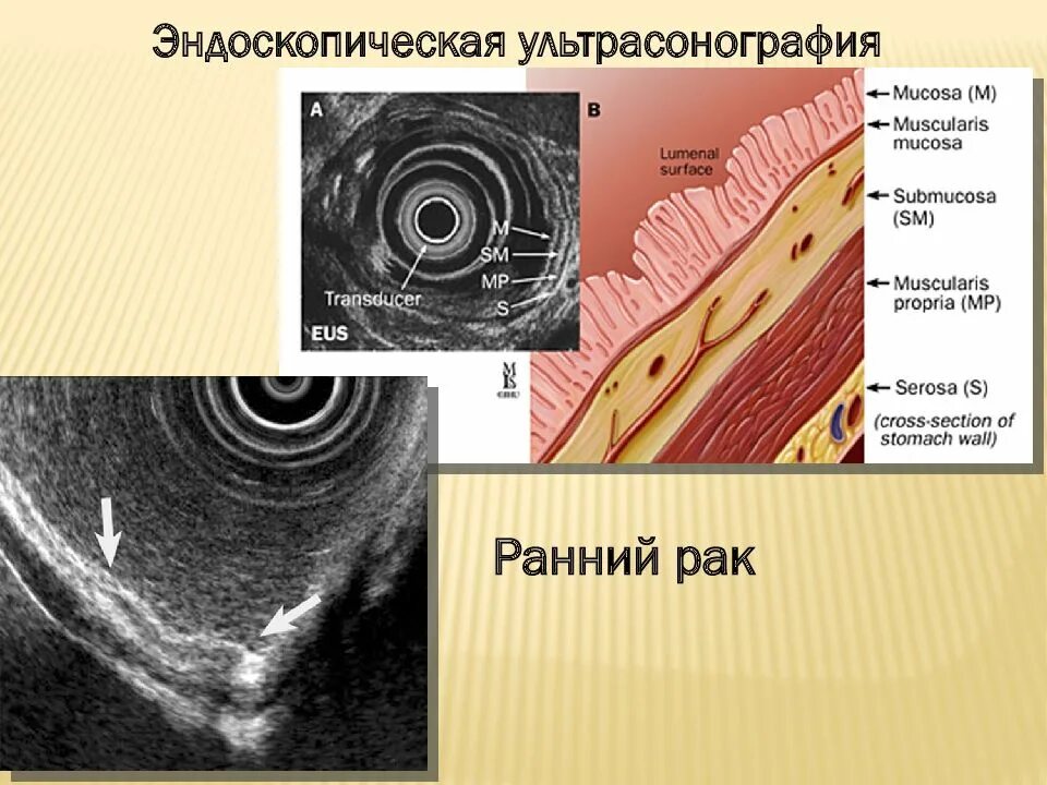 Эндосонографию желудка. Сонография поджелудочной железы. Эндоскопическая ультрасонография пищевода. Эус желудка