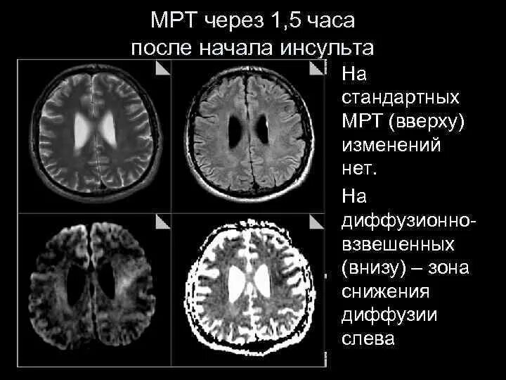 Очаг ограничения диффузии. Диффузно взвешенное изображение мрт. диффузионная мрт. ограничение диффузии на мрт. диффузионная мрт головного мозга.