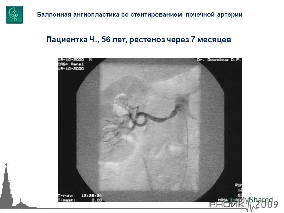 Баллонная ангиопластика почечной артерии. Ангиопластика почечных артерий. Стентирование почечной артерии. Стентирование сосудов почек. Стентирование почечной артерии.