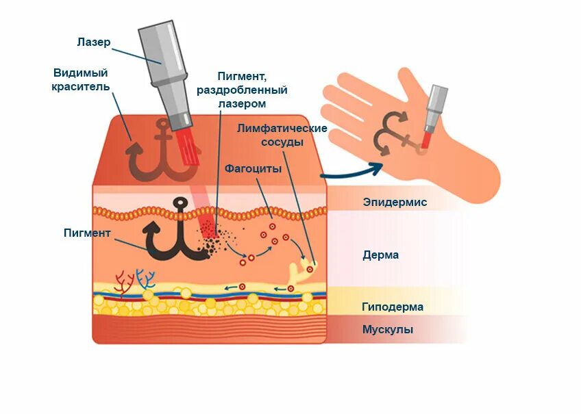 В собственно коже отсутствует пигмент. Воздействие лазера на кожу. Воздействие неодимового лазера на кожу. Влияние лазера на кожу человека. Введение пигмента в кожу.