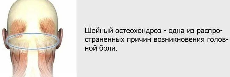 Немеет затылок причины. При головной боли. Головная боль при остеохондрозе. Боль в затылке при остеохондрозе. Боит голлва при остеохондроз.