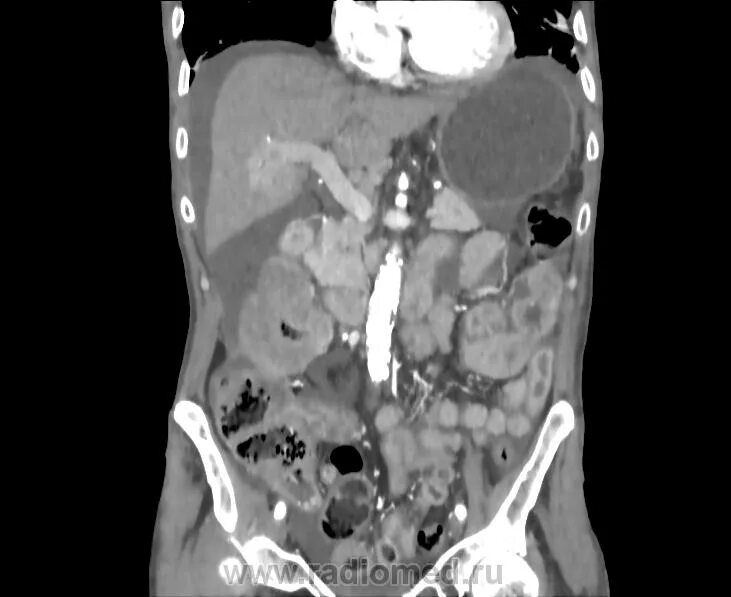Злокачественная кахексия. Кахексия у раковых больных. Кт органов брюшной полости грудной клетки