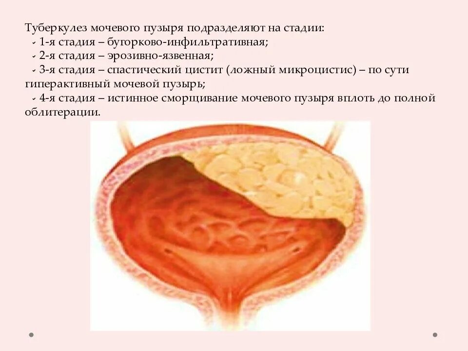 Какие симптомы мочевого пузыря. Туберкулез почек этиология. патан туберкулез почек. микроцистис мочевого пузыря. туберкулез мочевого пузыря макропрепарат.