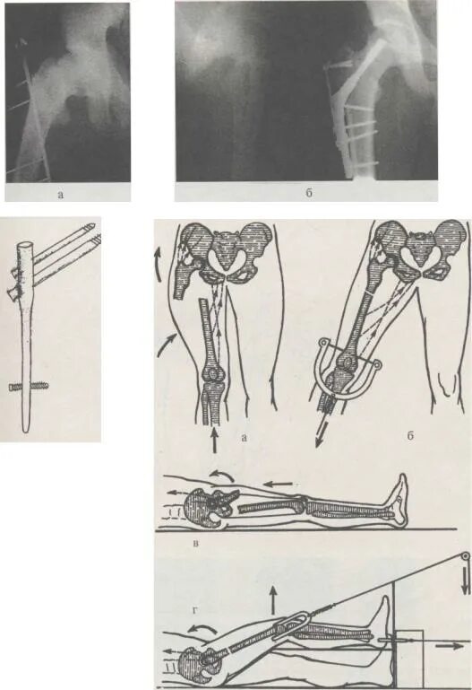 Оперативное лечение перелома костей. Экстрамедуллярный остеосинтез голени. Экстрамедуллярный (накостный) остеосинтез. Накостный остеосинтез голени. Монолокальный компрессионный остеосинтез.