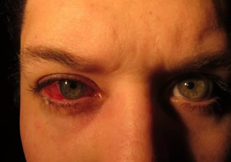 Глаза кровоточат. Субконъюнктивальное кровоизлияние и гифема. Подконъюнктивальный разрыв склеры.