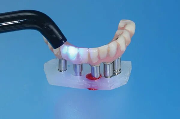 Протез на 2 имплантатах на нижней челюсти. Балочный протез на 4. Балочный протез на 4. Балочный протез на 4. Балочная фиксация съемных протезов.