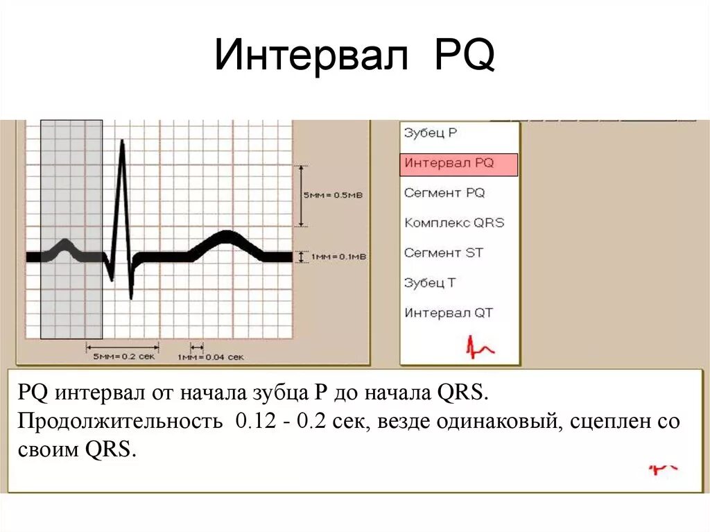 Увеличение интервала pq. Интервал PQ на ЭКГ. Интервал PQ на ЭКГ норма. Удлинение интервала PQ на ЭКГ. QRS интервал PQ.