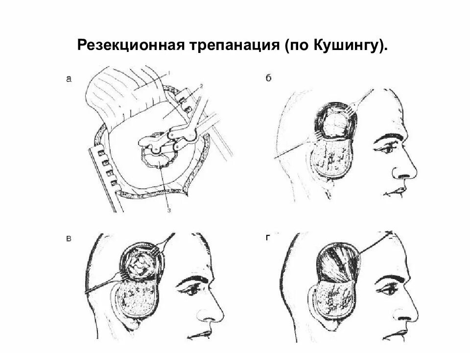 Трепанация топографическая анатомия. Декомпрессивная трепанация черепа показания. Декомпрессивная трепанация по кушингу. Трепанация черепа топографическая анатомия. Резекционная трепанация черепа по кушингу.