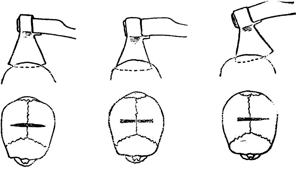 Колотый удар. Рубленые раны судебная медицина. Рубленное повреждение черепа.