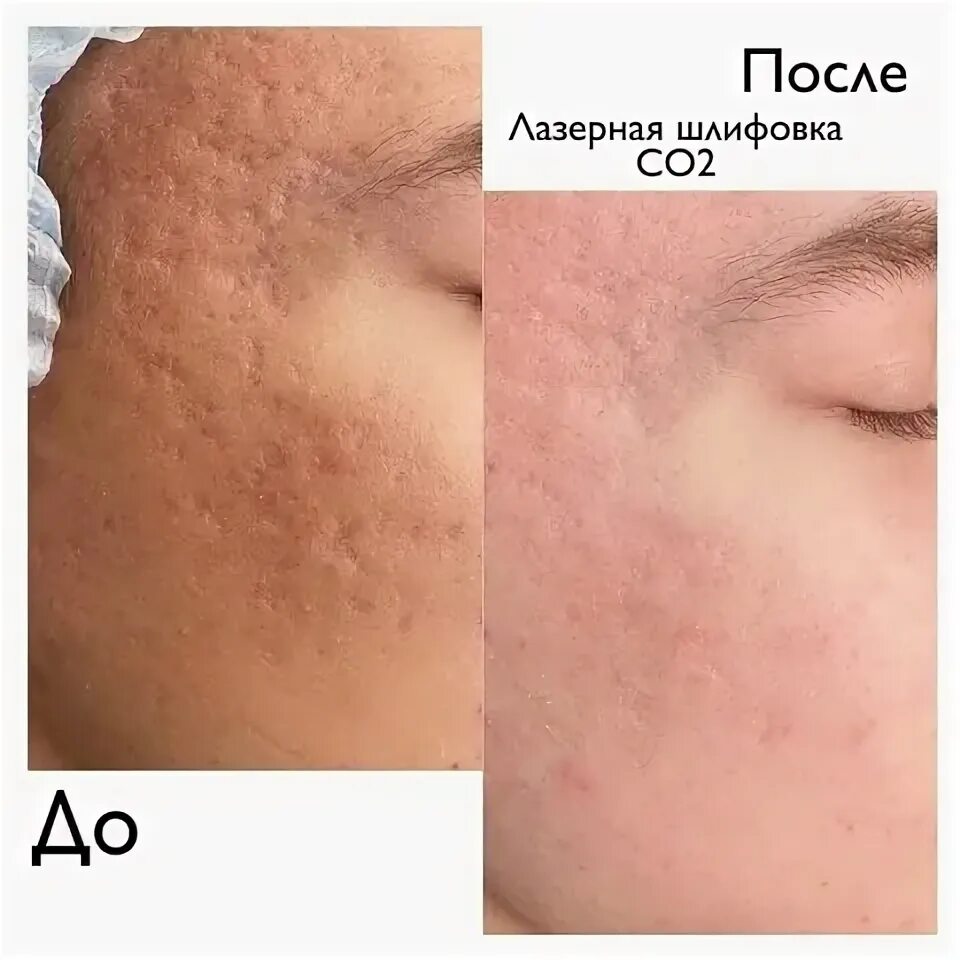 Когда можно умыться после лазерной коррекции