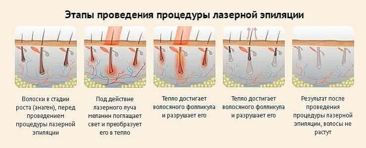 Интервал процедур лазерной эпиляции. Фазы роста волос и лазерная эпиляция. принцип действия лазера для эпиляции. воздействие лазера на волос. лазерная эпиляция воздействие на волос.