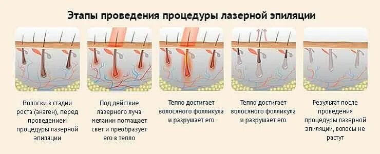 Как часто можно делать лазерную. Фазы роста волос и лазерная эпиляция. Лазерная эпиляция схема. Принцип действия лазера для эпиляции. Действие лазера на волос.