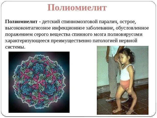 Симптомы полиомиелита полиомиелита. Спинальная форма полиомиелита. Полиомиелит инфекционные болезни. Полиомиелит вызывается. Клинические проявления полиомиелита.