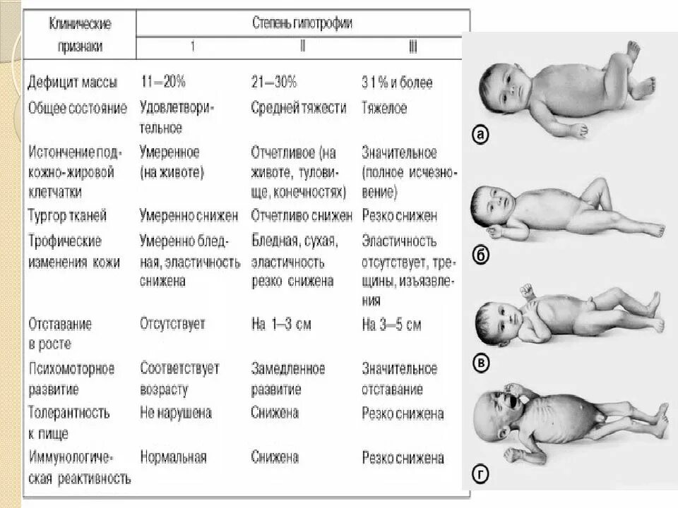 Группа д у ребенка. Клинические симптомы гипотрофии. Гипотрофия 1 степени у детей диагностика. Клинические признаки гипотрофии новорожденных. Гипотрофия у детей раннего возраста степени.