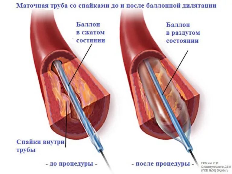 Что такое спайка в маточной трубке. Маточные трубы в спайках.