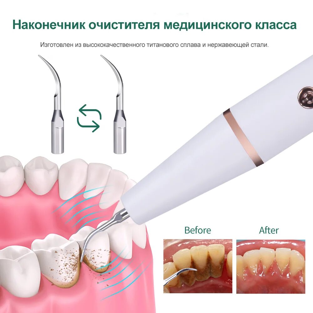 Удалить камни ультразвуком