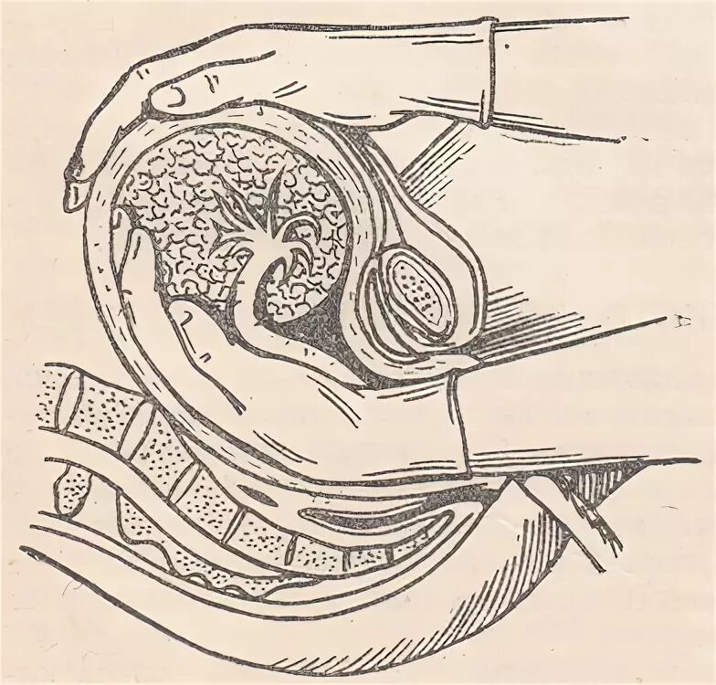 Ручное отделение плаценты. Ручное обследование матки. Отделение последа вручную. Можно достать до матки