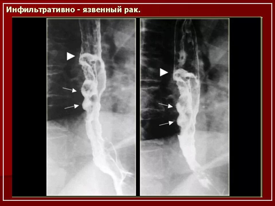 Пищевода выживаемость