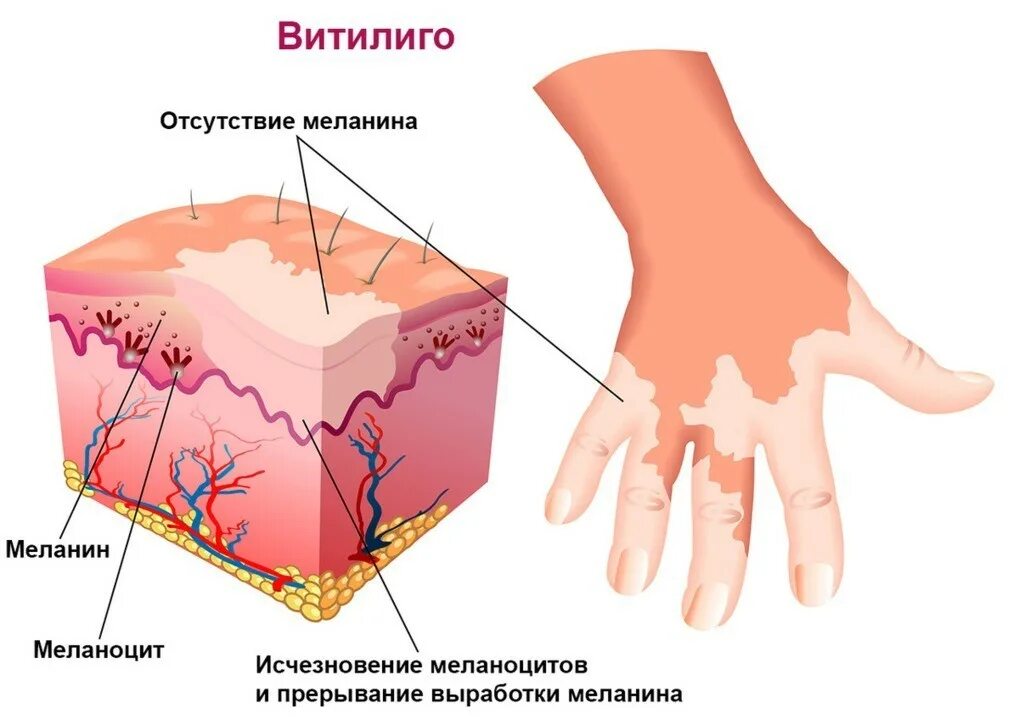 В собственно коже отсутствует пигмент. Меланоциты меланин кожа. Витилиго аутоиммунное заболевание.