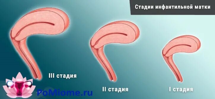 Гипоплазия матки. Стадии инфантильной матки.