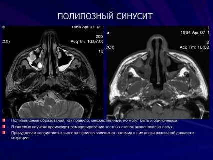 Полипозный гайморит