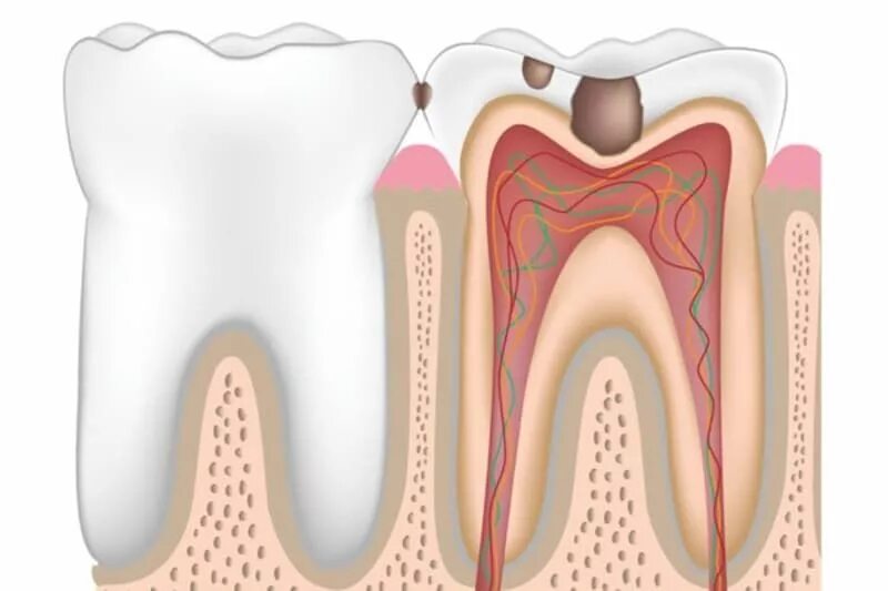 Пульпит - воспаление пульпы зуба. Строение зуба кариес пульпит. Строение зуба пульпа эмаль. Видимая часть зуба