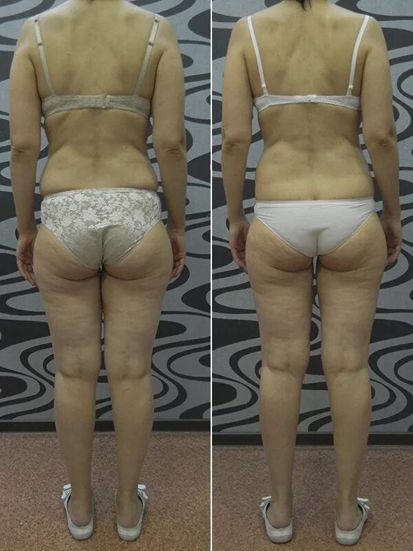 эффект от массажа. липодистрофия целлюлит. вакуумно-баночный массаж аппаратный. эффект после антицеллюлитного массажа. медовый массаж до и после.