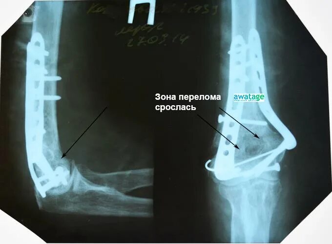 Что такое консолидация перелома. Срастание перелома плечевой кости. Консолидация кости при переломе. Костная мозоль при переломе. Костная мозоль на рентгене лучевой кости.