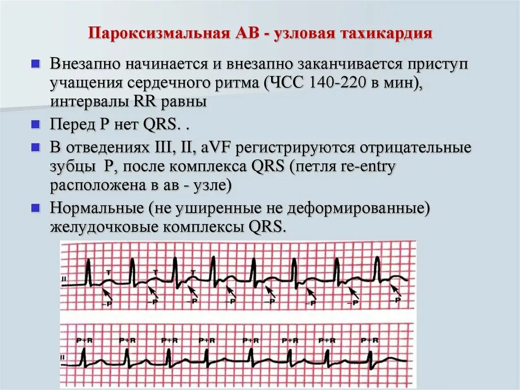 При учащении пульса длительность сердечного цикла. Av реципрокная пароксизмальная тахикардия ЭКГ. Av Узловая реципрокная тахикардии ЭКГ. АВ Узловая реципрокная тахикардия на ЭКГ. АВ Узловая тахикардия на ЭКГ.