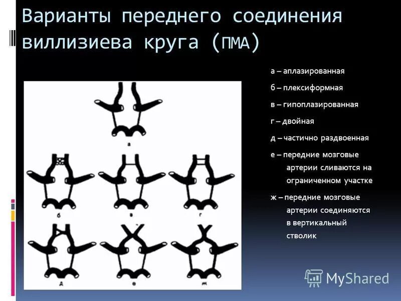 Развитие виллизиева круга в виде отсутствия кровотока. Трифуркация внутренней сонной артерии. Варианты строения Виллизиева круга мрт. Сегменты артерий Виллизиева круга. Аномалии строения Виллизиева круга.