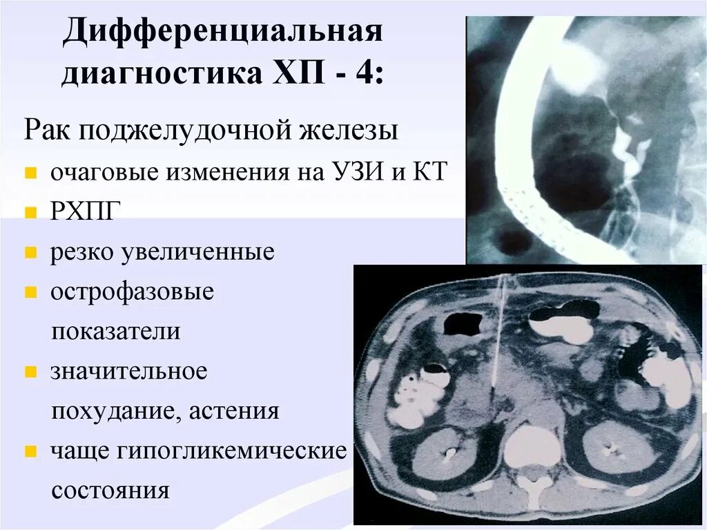 Очаговые изменения поджелудочной