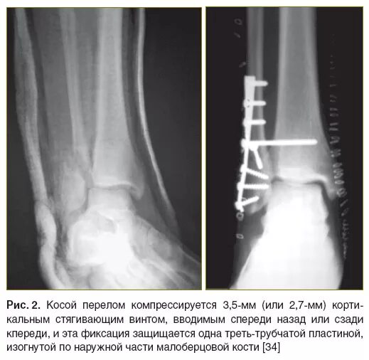 Перелом лодыжки форум вумен. Экстрамедуллярный остеосинтез лодыжки. Голеностопный сустав перелом малоберцовой кости. Остеосинтез двухлодыжечный перелом. Абдукционный перелом лодыжки.