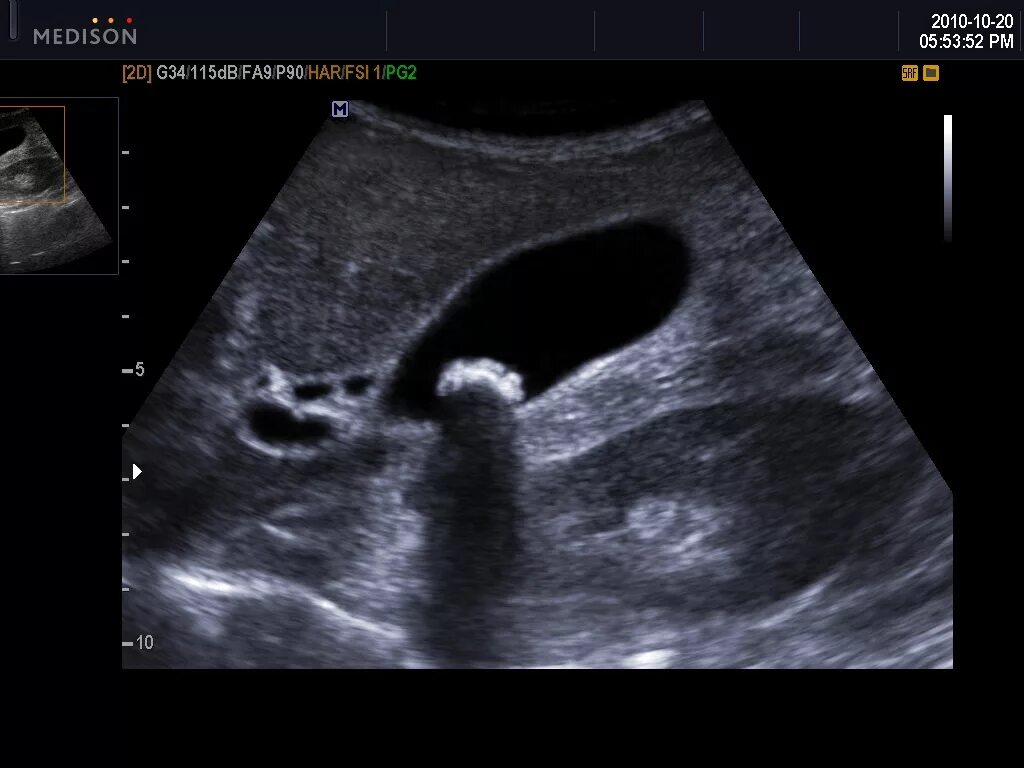 патология желчного пузыря на узи. узи брюшной полости желчный пузырь. отключенный желчный пузырь на узи. ультразвуковое исследование желчного пузыря. узи печени и желчного пузыря.