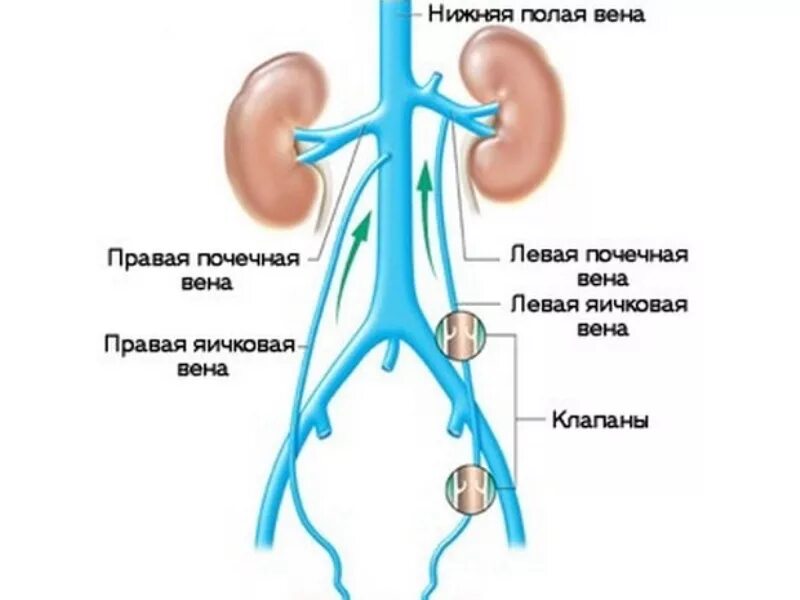 Расширение семенной вены. Почечная Вена и нижняя полая Вена. Нижняя полая Вена схема. Нижняя полая Вена в почке. Нижняя полая Вена (v. Cava inferior).